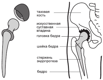 Артроз. Самые эффективные методы лечения Артроз. Самые эффективные методы лечения